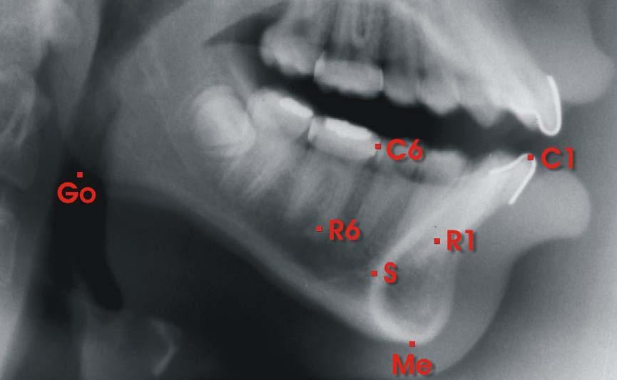 CASUÍSTICA MATERIAL E MÉTODOS 126 Figura 4.21 Pontos cefalométricos utilizados no estudo das alterações dentárias no arco inferior Figura 4.