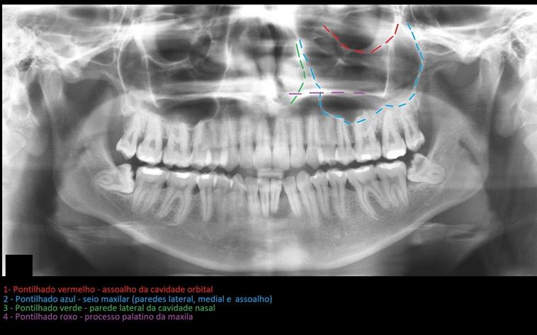 O seio maxilar, reparo anatômico que se mostra bastante evidente radiograficamente, é uma importante cavidade pneumática, que ocupa o interior do corpo do osso da maxila e é o mais volumoso dos seios