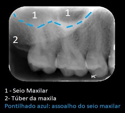 Radiografia periapical da região de