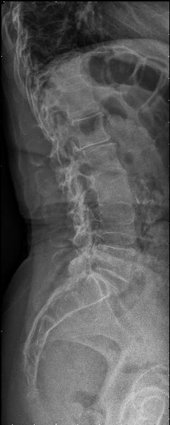 A B C Imagens nº 6, 7 e 8: Imagens de Teleradiografia da coluna vertebral corte coronal.    12