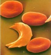 Capítulo 4 - Proposta de Dissertação 66 O que diferencia a AF da anemia comum é que na primeira a hemoglobina A (comum) é substituída pela hemoglobina S (formato de foice, daí o nome falciforme,