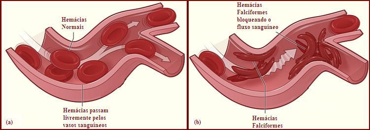 Estima-se que 90% dos casos de anemia é devido à falta de ferro, conhecida como Anemia Ferropriva (MINISTÉRIO DA SAÚDE, 2004). Figura 4.3 - Hemácia no formato de foice (meia lua).