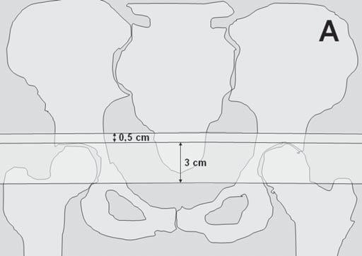 teral na bexiga foram, em média, 11,8 ± 8,0 mm e 8,3 ± 8,0 mm abaixo do teto acetabular (p = 0,17) e, em média, 27,7 ± 9,2 mm e 33,9 ± 8,8 mm acima da borda superior da sínfise púbica (p = 0,34),