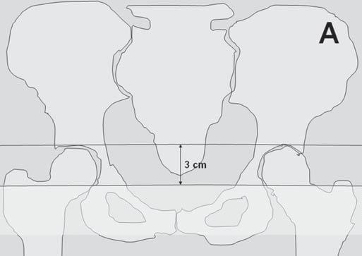 Definição do nível da junção ureterovesical pela tomografia computadorizada Figura 6.