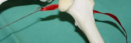 Figura 12b Imagem esquemática da passagem do implante de fáscia lata bubalina