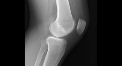 20 Capítulo 3. Diagnóstico por Imagem Fig. 3.2: Exemplo de imagem de RX de perfil externo do joelho esquerdo.