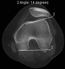 10: Medição do ângulo da vertente externa do côndilo femoral: (a) Representação esquemática para a realização da medição do ângulo, retirado de [11]; Medida do ângulo de vertente externa em imagem TC.