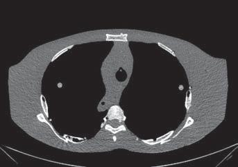 Correia PD et al. / lindagem protetora de mamas para redução de dose em TC placas de espessura em chumbo conhecidas. espessura equivalente em chumbo encontrada para a manta foi 0,037 ± 0,016 mmpb.