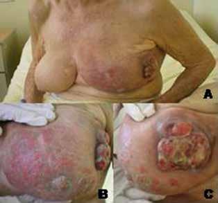 CASE REPORT Palavras-chave. Câncer de mama; idoso; diagnóstico tardio; fatores socioeconômicos INTRODUCTION Breast cancer is the main malignancy affecting women worldwide.