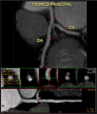 10 BOLETIM EDUCATIVO SOLACI APRESENTAÇÃO DE CASOS Angioplastia com stent eluidor de fármacos em tronco principal guiada por tomografia coronária de 64 cortes // Dres.