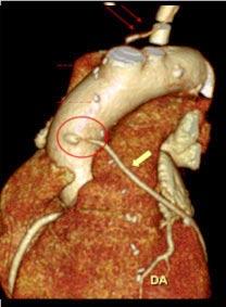 vermelhas ponteadas). Identifica-se enxerto venoso (seta grossa amarela) dirigido para o segundo ramo marginal obtuso de artéria circunflexa.