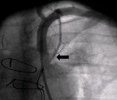 Enxerto venoso aorto-coronário (safena-segunda obtusa marginal da circunflexa) com lesão severa localizada na anastomose proximal (círculo preto).