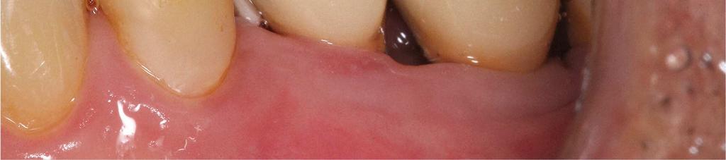 região de pré-molar