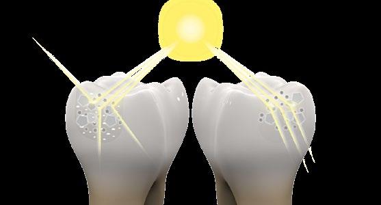 restaurações estéticas de forma simples e com extrema capacidade de mimetismo com os dentes naturais.