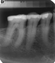 radiográficas periapicais de referência dos três padrões ósseos trabeculares, em maxila e mandíbula, publicadas no