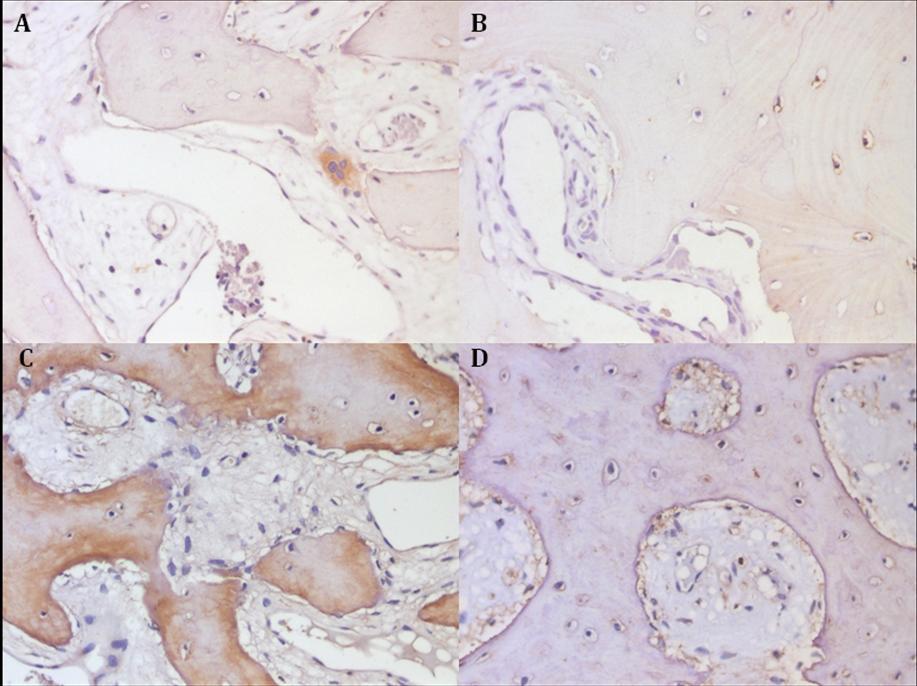 Figure 3 Representative immunohistochemical expression of bone remodeling markers (A) RANK; (B) RANKL; (C) Osteocalcin and (D) OPG
