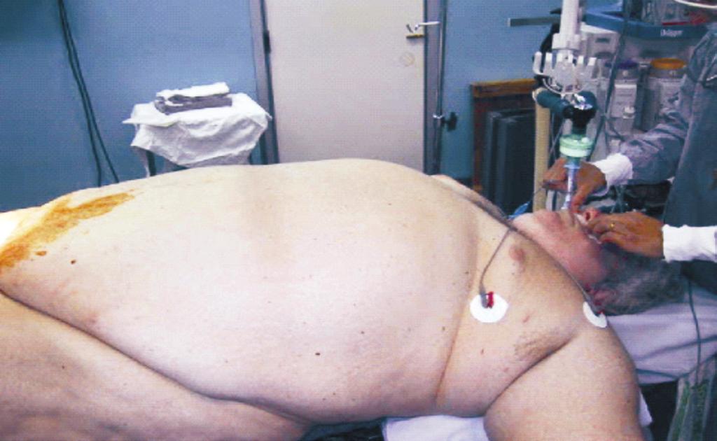 140 sic gastroenterologia 1. Introdução Figura 1 - Paciente com obesidade mórbida A prevalência da obesidade vem aumentando de modo significativo nas últimas décadas.
