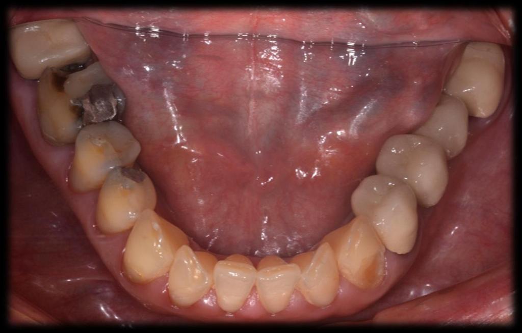 14 Figura 6: Aspecto clínico da arcada inferior, mostrando diferentes materiais restauradores.