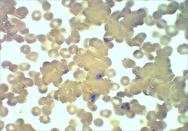 São mostrados apenas os índices de reatividade maiores que 1. Apenas dois pacientes infectados apresentaram plasma com alta reatividade à proteína alvo, 1 e 6..3.