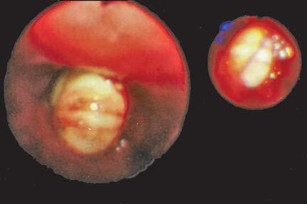 2 cm de comprimento (setas) Fig.