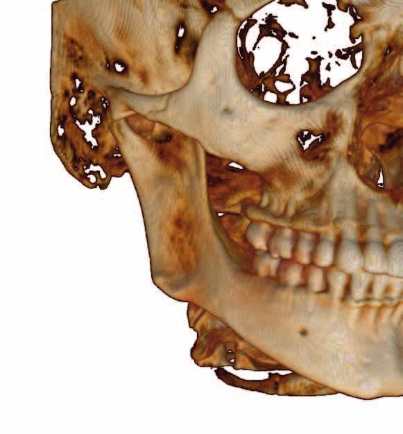 [ Diagnósticos de excelência ] Imagiologia 3D que faz mais do que ajudar a identificar um problema também permite ver todos os detalhes Ao levarmos a tecnologia 3D para as clínicas dentárias,