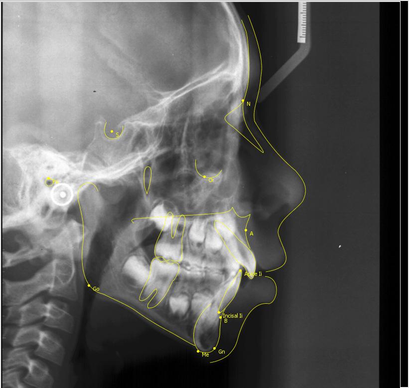 Figura 3 - Marcação dos Pontos Cefalométricos referentes a Análise de Tweed. Após a marcação dos pontos cefalométricos, o traçado e o relatório com todas as medidas foram gerados pelo software.
