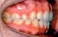 de dentes permanentes