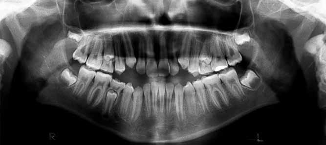 Figura 4 - Radiografia de