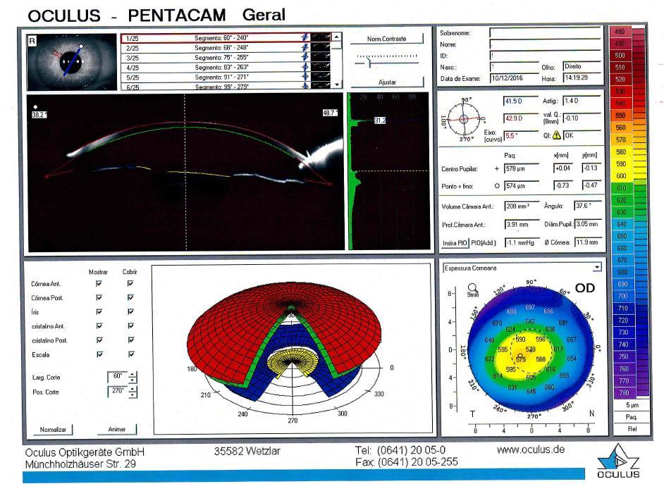 Figura 1.7 Exemplo de uma folha de resultado do Pentacam HR.