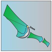 A osteotomia de Weil é feita com uma serra oscilante, e deve iniciar na cartilagem articular, 2 mm plantar à margem superior da superfície articular da
