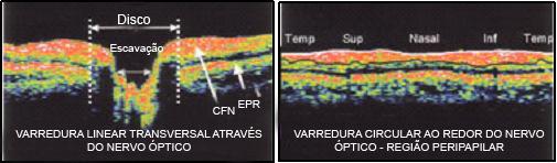 INTRODUÇÃO 31 Figura 4- Representação das camadas retinianas pelo OCT. Em 2007, chegaram ao mercado os OCTs de altíssima resolução (3-5μm) 73-75, o Cirrus HD-OCT 76 (Carl Zeiss Meditec Inc.