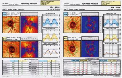 INTRODUÇÃO 37 A B Figura 10- Exemplos de exames realizados com o GDx para análise da CFN. (A) NO saudável em ambos os olhos. (B) NO com glaucoma em ambos os olhos. 1.3. JUSTIFICATIVA DO ESTUDO As causas da perda de células ganglionares no glaucoma ainda é motivo de controvérsia no meio científico.