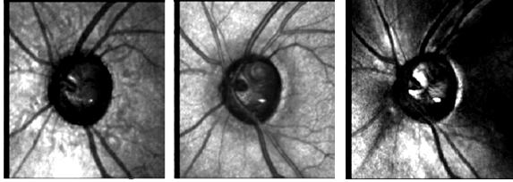 CFN também irregular. A B C D E D E Figura 14- Imagens Polarimétricas em olho com defeito na camada de fibras nervosas. (A) Imagem Despolarizada. (B) Imagem Confocal. (C) Birrefringência.