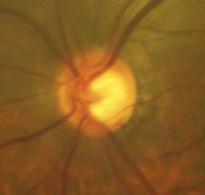 RESULTADOS 60 camadas retinianas profundas e a luz dispersa em decorrência de artefatos no segmento anterior do olho.