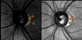 Área de atrofia bem delimitada em ambas as imagens calculadas pela análise polarimétrica, porém de contornos menos nítidos na retinografia.