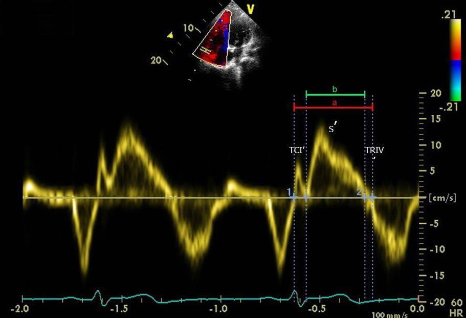 3 Material e Métodos 29 Figura 5 - Análise dos intervalos de tempo durante o ciclo cardíaco pelo Doppler tecidual ao nível do anel da valva tricúspide e cálculo do índice de performance miocárdica