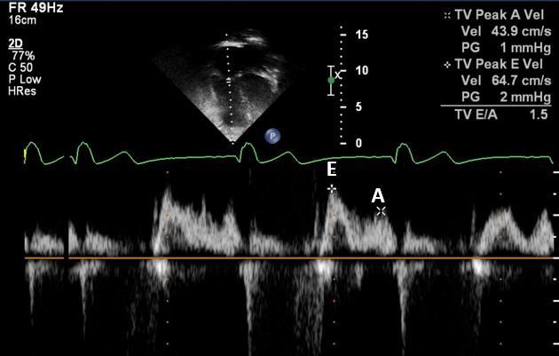 3 Material e Métodos 31 quatro câmaras, aferindo o pico de velocidade da onda de enchimento diastólico precoce (E) e da onda de contração atrial (A) (Figura 7).