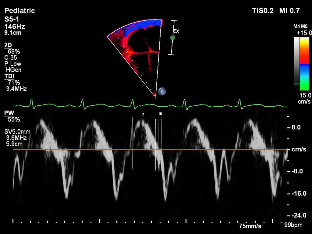 3 Material e Métodos 34 Figura 10 Análise dos intervalos de tempo durante o ciclo cardíaco pelo Doppler tecidual ao nível do anel da valva tricúspide para o cálculo do tempo correspondente ao pico do