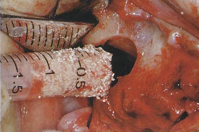G) A cureta desliza ao longo do assoalho do seio aproximadamente 5mm a partir da janela óssea; H) A mucosa do seio é suavemente descolada da parede medial do seio