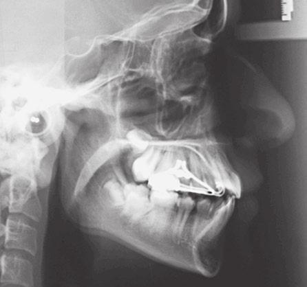 Má oclusão de Classe I de ngle, com tendência à classe III esquelética, tratada com controle de crescimento FIGUR 16 - Radiografia cefalométrica de perfil () e traçado cefalométrico (), após a