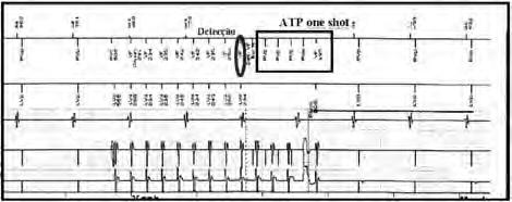 ATP One Shot na Zona de FV Liberação de uma tentativa de ATP em Zona de FV antes da carga do choque a fim de reverter TV rápida, evitando desta forma a liberação de choques dolorosos.