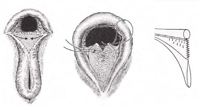 É feita uma incisão que começa na margem craneal do corpo perineal, continua-se perifericamente ao longo do tecido cicatricial até à comissura dorsal da vulva, formando dois lados de um triângulo.