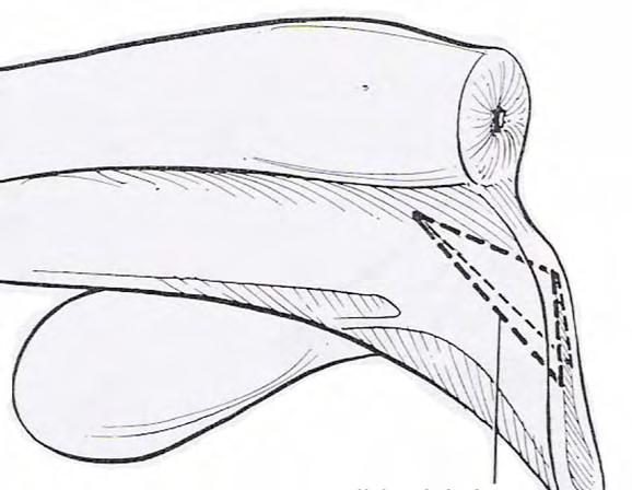 sutura, faz-se uma incisão desde um ponto no tecto do vestíbulo, 3 a 6 cm caudalmente à união vestibulovaginal até à marca feita em cada lábio vulvar.