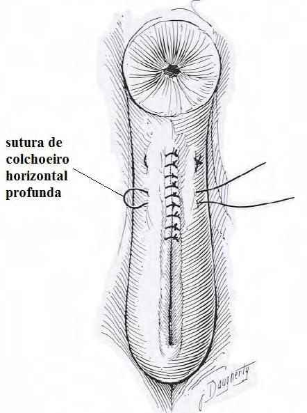 Esta dissecção deve ser cuidada para não atingir o recto (se isso acontecer o defeito deve ser Imagem 19. Linhas de incisão numa Episioplastia 29.