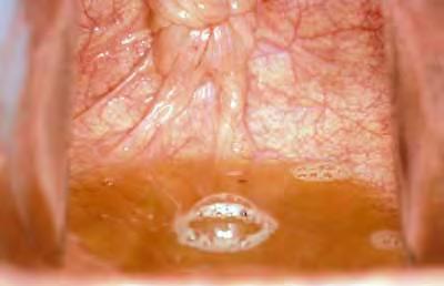 6.3. UROVAGINA Introdução: Urovagina, ou refluxo vesicovaginal, refere-se à acumulação de urina na porção anterior da vagina (Imagem 22).