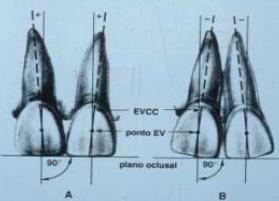 No caso dos molares corresponde ao sulco vestibular que separa as duas cúspides vestibulares (figura 2-A).
