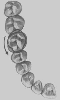 Para que a inclinação seja considerada positiva a porção oclusal/incisal tem de estar vestibularizada em relação à porção cervical, caso esteja lingualizada a inclinação já é considerada negativa,