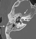 equimose periorbital ( olhos de guaxinim )