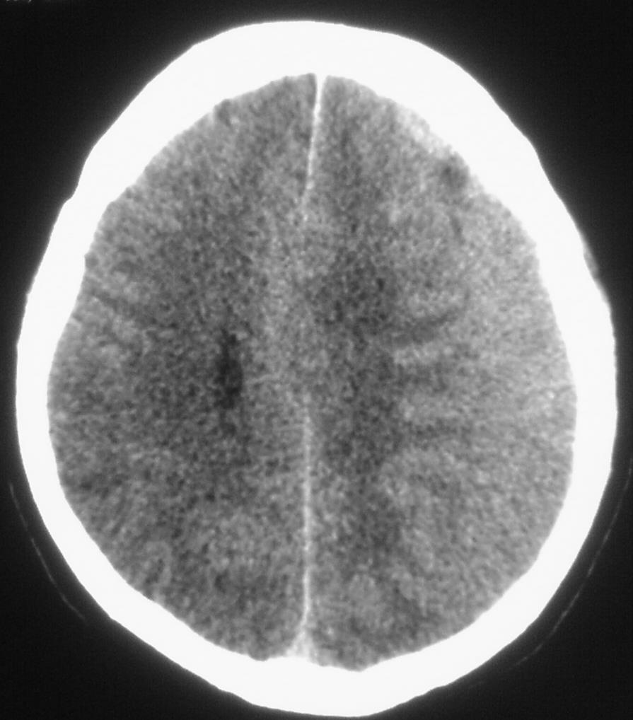 Hematoma