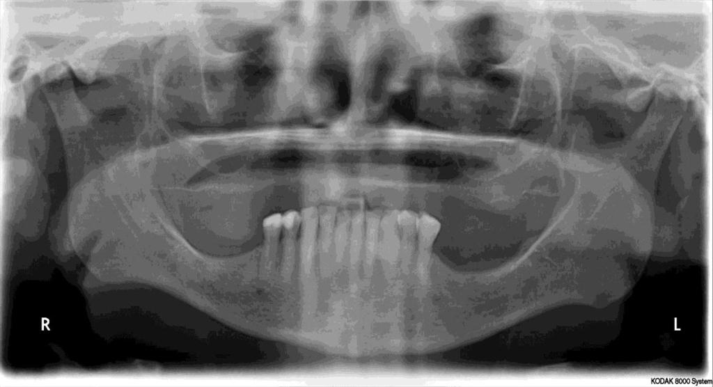 13 - Cortical classificada como Q1 Q2 = cortical mandibular